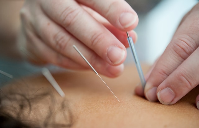 Close-up of acupuncture needles in a patient's back, focusing on the pain relief aspect of acupuncture therapy.